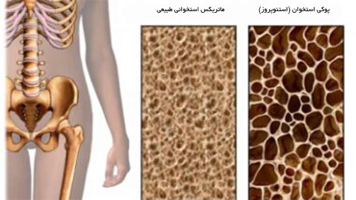 آموزشی پوکی استخوان