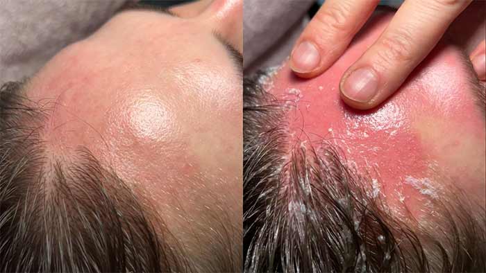 سلامتی تحریک پوست سر، آلرژی و التهاب